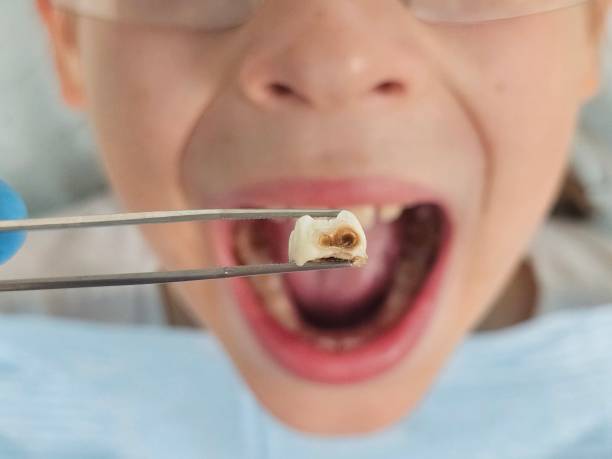 Best Emergency Dentist for Lost Fillings or Crowns in Westbrook, ME